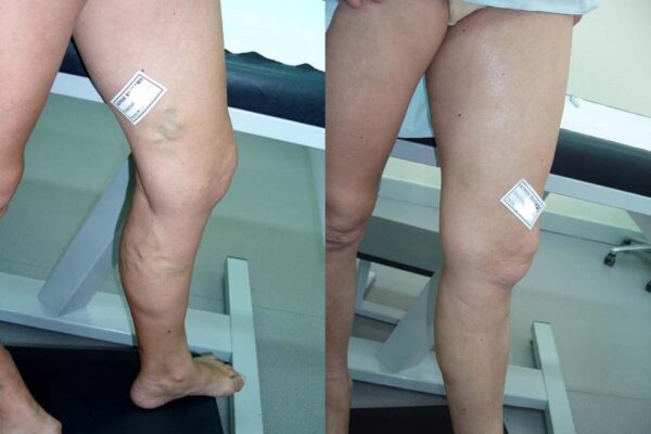 Ένας μήνας μετά την θεραπεία