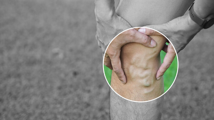 Ανεπαρκής Φλέβα Κιρσός