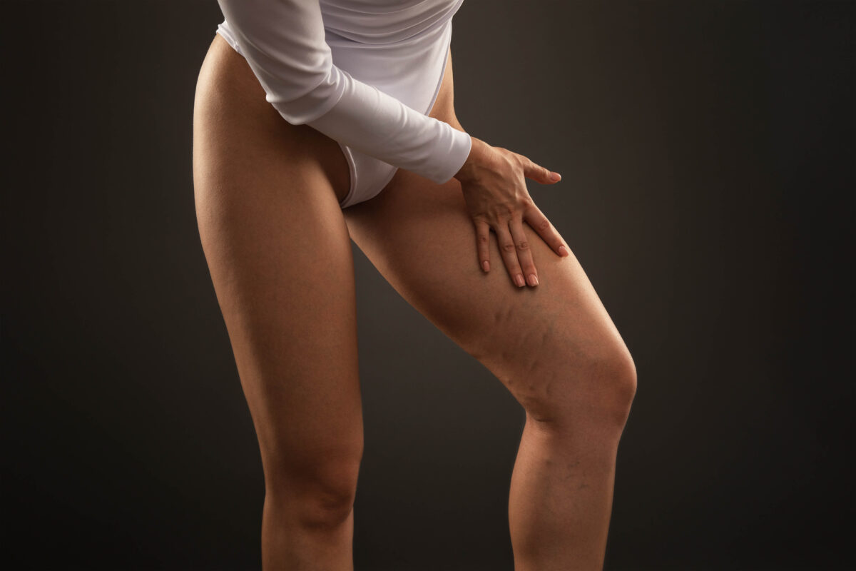 κιρσοί και θεραπεία τους