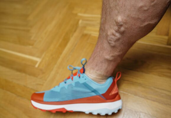 Κιρσοί & ευρυαγγείες στα πόδια