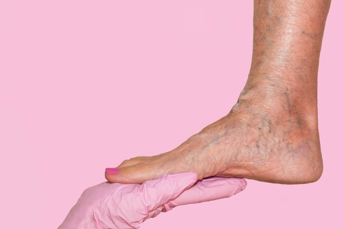 Κιρσοί & ευρυαγγείες στα πόδια