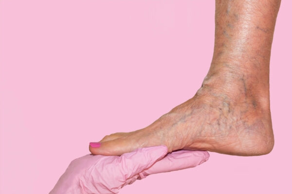 Κιρσοί & ευρυαγγείες στα πόδια