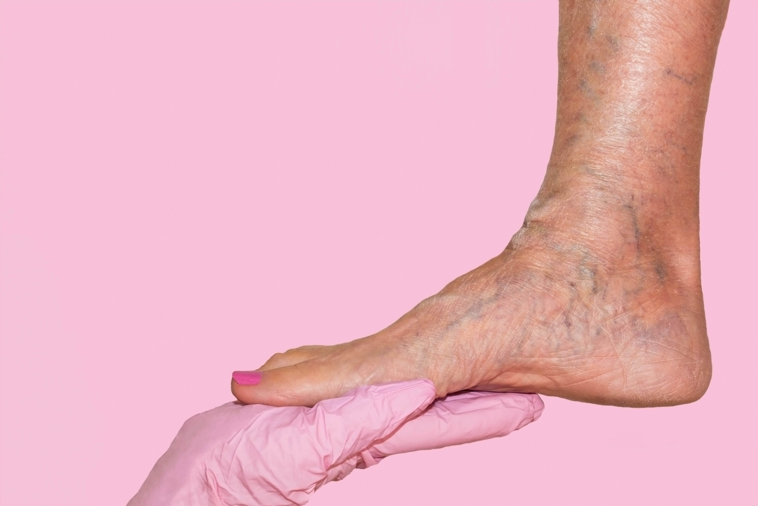 Κιρσοί & ευρυαγγείες στα πόδια